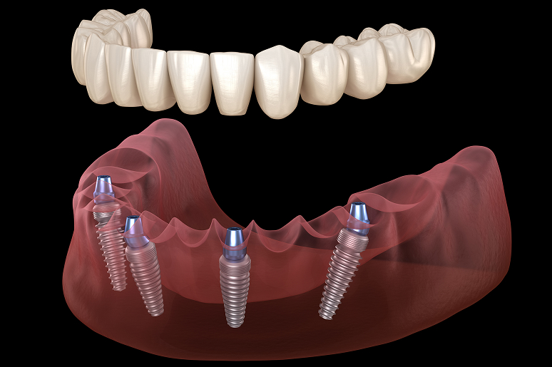 All-on-4 dental implants Los Angeles CA