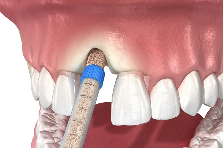 Bone grafting for dental implants Los Angeles CA