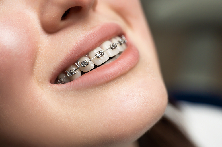 Ceramic braces at Trusted Dental Los Angeles