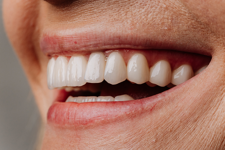 Cosmetic dentistry smile transformation at Trusted Dental Los Angeles CA