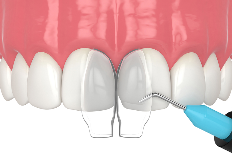 Dental bonding before and after Trusted Dental Los Angeles CA