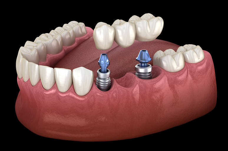 Dental bridge process at Trusted Dental Los Angeles