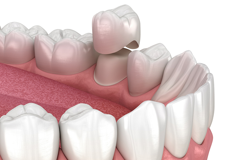 Same-day CEREC dental crown at Trusted Dental Los Angeles CA