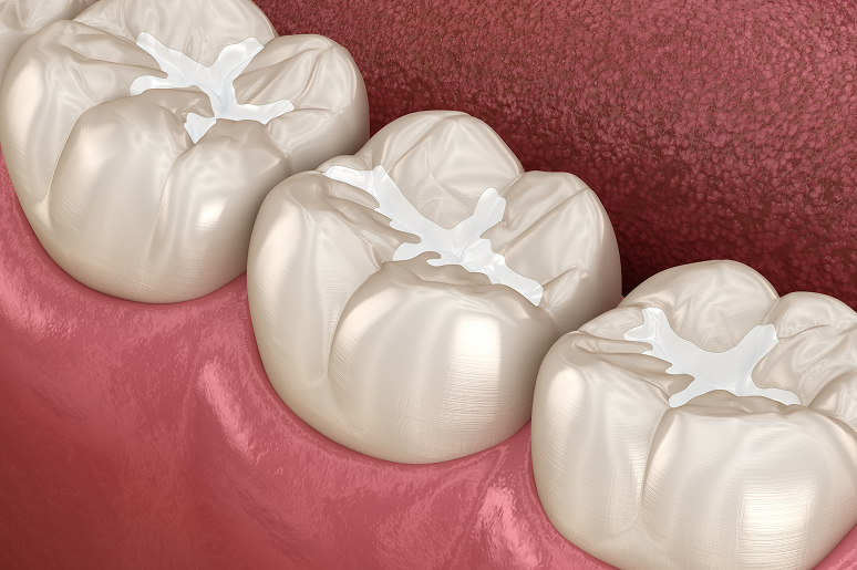 Tooth-colored composite filling Los Angeles CA