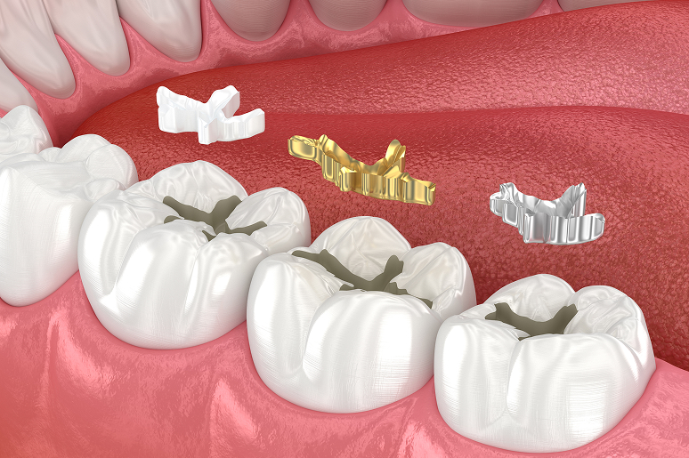 Replacing old metal fillings with tooth-colored composites