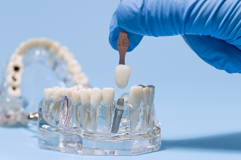 Dental implants in Los Angeles CA at Trusted Dental & Orthodontics