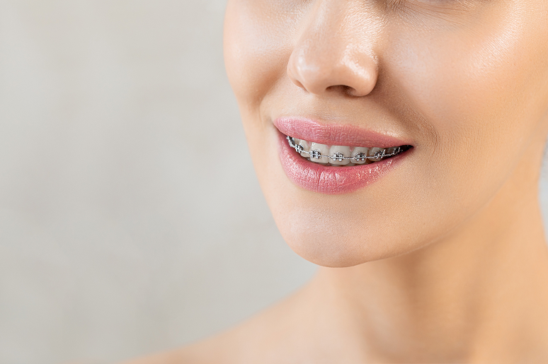 Metal braces treatment at Trusted Dental Los Angeles CA
