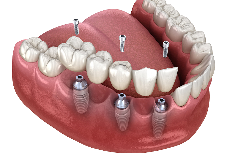 Multiple tooth implants Los Angeles CA