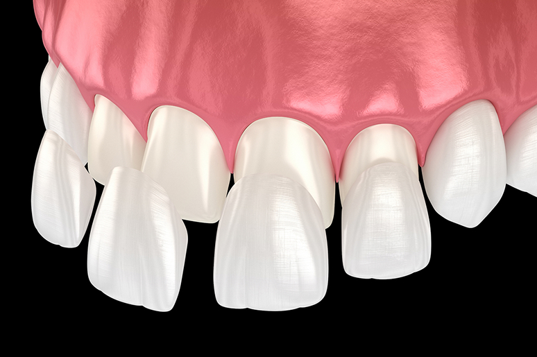 Porcelain veneers before and after Trusted Dental Los Angeles
