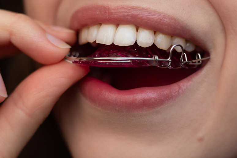 Orthodontic retainers Los Angeles CA Trusted Dental