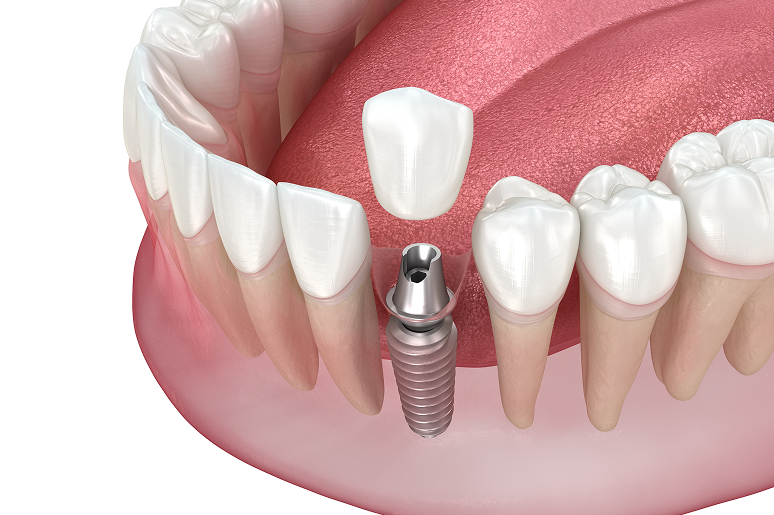 Single tooth dental implant in Los Angeles CA