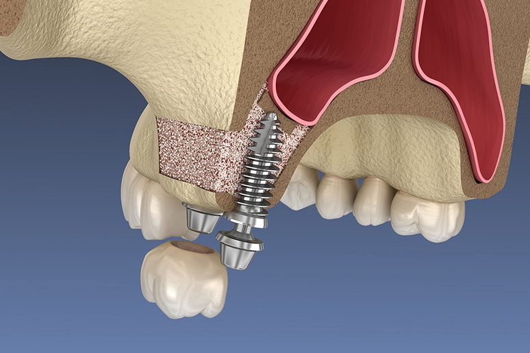Sinus lift surgery for dental implants Los Angeles CA