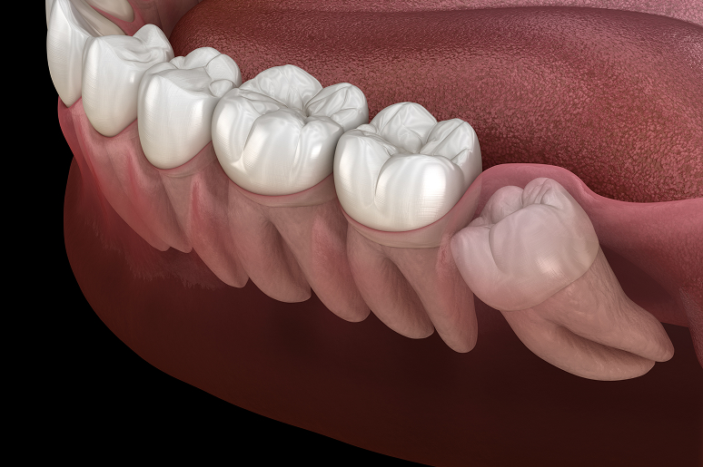 Wisdom teeth removal at Trusted Dental Los Angeles CA